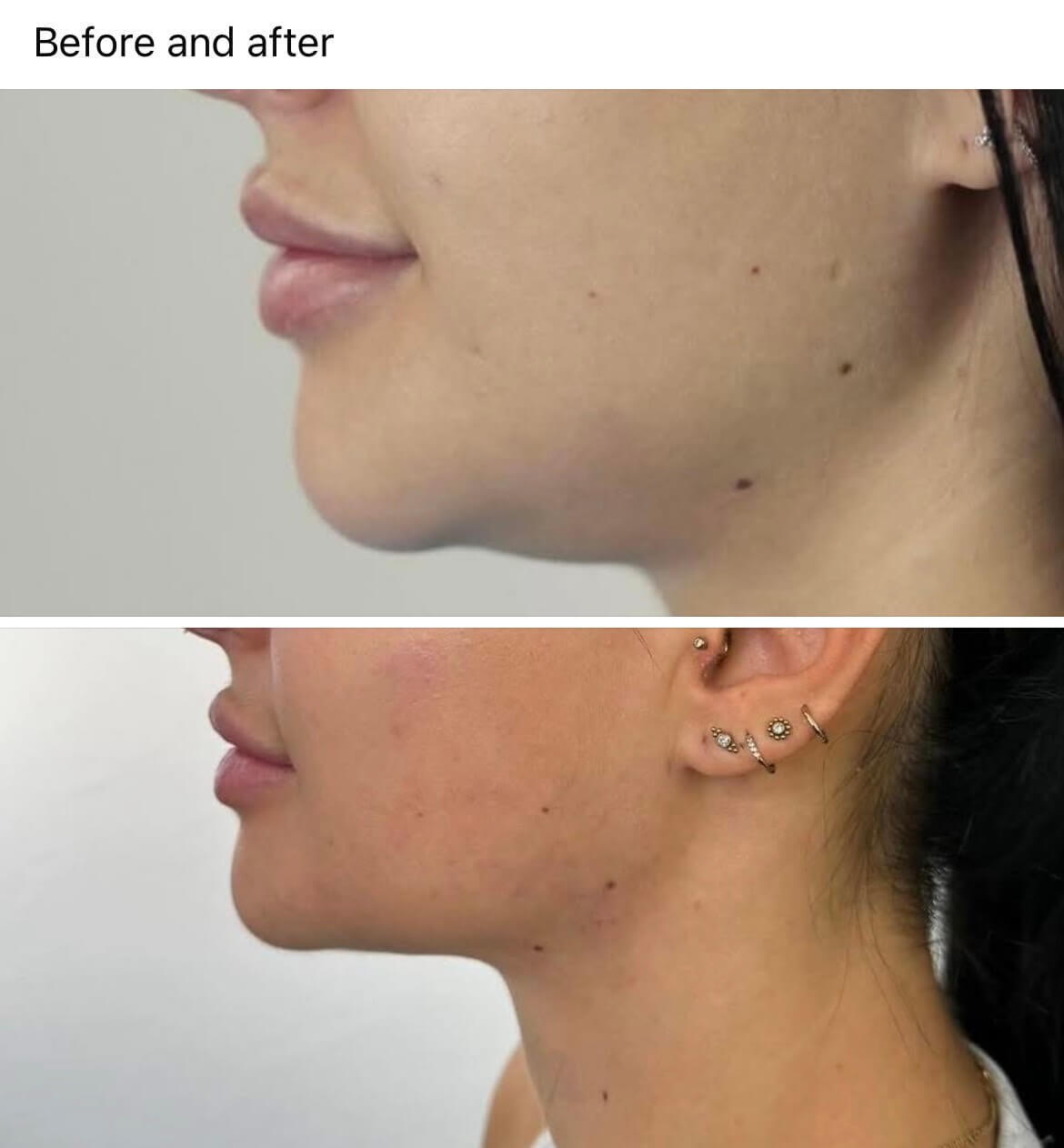Face Shape Fillers